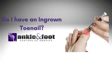 Sandy Springs Podiatrist Provides Ingrown Toenail Treatment To Atlanta