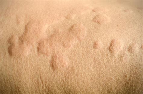 Top 9 Itchy Skin At Night With Bumps On Skin 2022