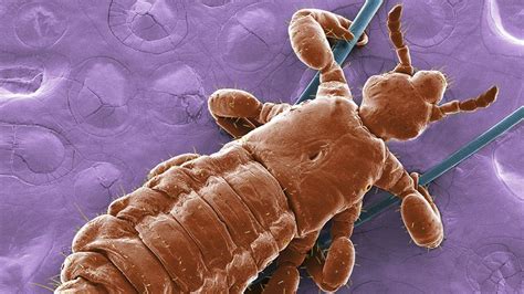 Itchy Business The Growth Of Head Lice Removal Firms Bbc News