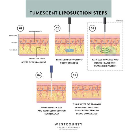 Liposuction St Louis West County Plastic Surgeons