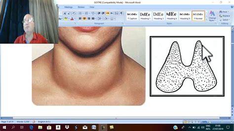 Thyroid Disorders In English 5 Physiological Goitre Part 2 By Dr