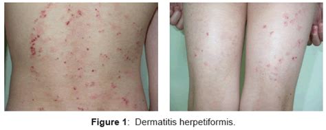 Celiac Disease With Dermatitis Herpetiformis Case Report
