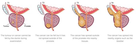 Sunshine Coast Urology What Is Prostate Cancer