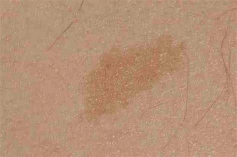 Skin Cancer Spots Pictures