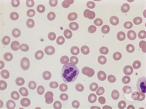 Normochromic Normocytic Anemia 1