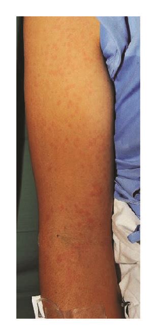 A Salmon Pink Rash At Forearm B Normal Epidermis With No Necrotic