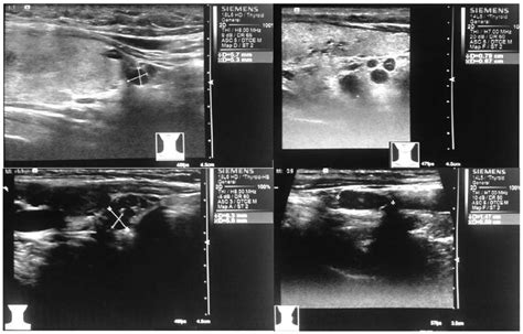 High Frequency Color Doppler Ultrasonography For Metastatic Lymph Nodes