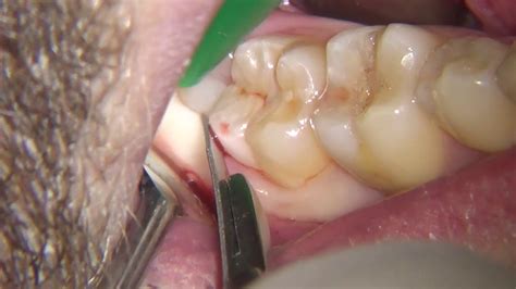 Extraction Of Impacted Third Molar Wisdom Tooth Youtube