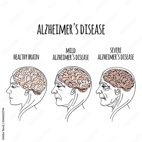 Dementia Alzheimer Disease Memory Loss Brain Damage Medicine Health