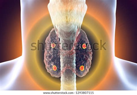 Parathyroid Glands Thyroid Gland Anatomy 3d Stock Illustration 1293807115
