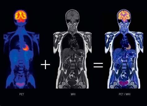 Petmri Stony Brook University School Of Medicine