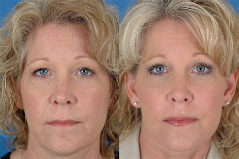 Facelift 3 Dallas Advanced Facial Plastic Surgery Center