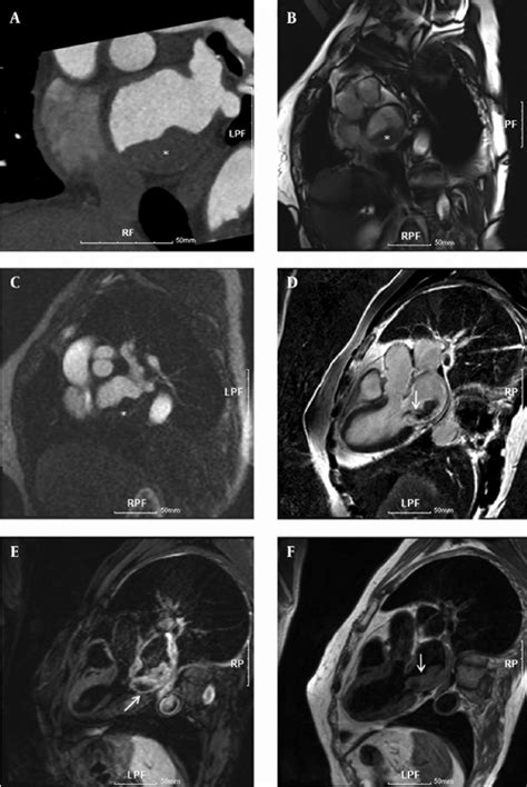 A 73 Year Old Woman With Dyspnea And Chest Pain Cardiac Ct And Mr