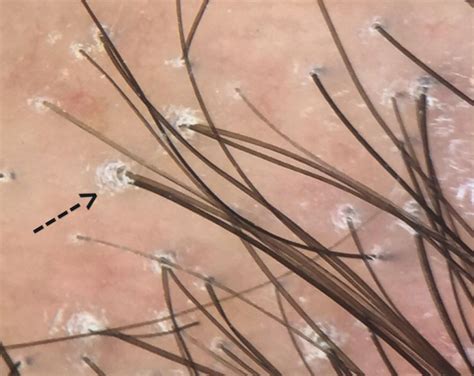 lichen planopilaris a closer look at follicular hyperkeratosis — donovan hair clinic