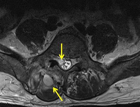 Pyogenic Spondylodiscitis With Paraspinal Abscess Radiology Cases
