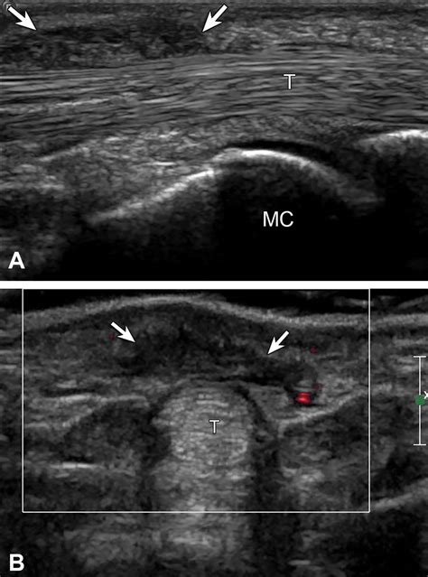 Ultrasound Features Of Palmar Fibromatosis Or Dupuytren Contracture