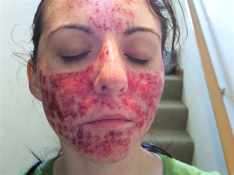 Day Of 1 Cystic Acne Scar Revision Pictures And Videos