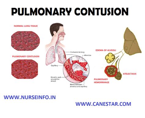 Pulmonary Contusion Nurse Info