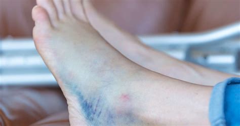 Bruised Heel Remedies And When To See A Doctor