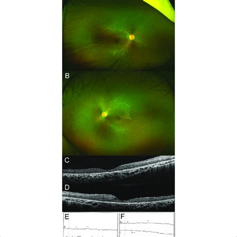 Ultra Widefield Fundus Photograph Of Right A And Left B Eyes