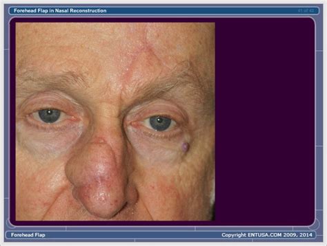 Nasal Skin Basal Cell Carcinoma Forehead Flap Html