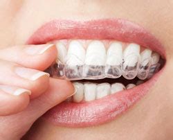 After all, retention devices are a form of braces anyway. How often should I wear my Invisalign retainers? - Dentist ...