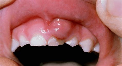 A Bump On The Gum In A Child Above The Tooth Purulent White What To Do