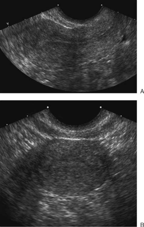 The uterus is the biggest organ of the female reproductive system and where the entire gestation is performed. ULTRASOUND EVALUATION OF THE UTERUS | Radiology Key