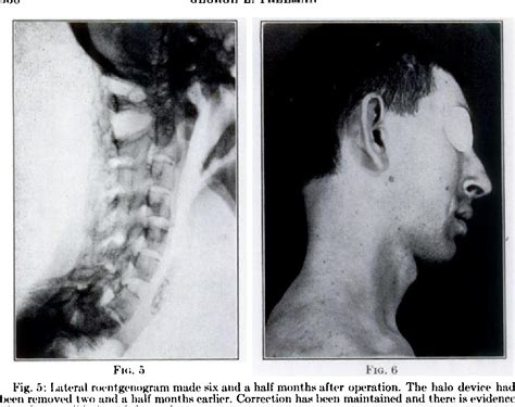 Figure 5 From Correction Of Severe Deformity Of The Cervical Spine In