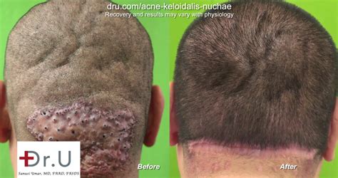 Acne Keloidalis Nuchae Site Archives Dr U Hair And Skin Clinic Fue