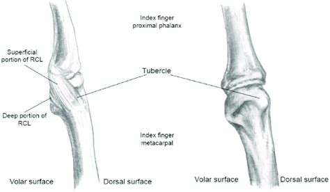 Radial Collateral Ligament At The Index Finger Mcp Joint Highlighting
