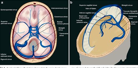 Cerebral Venous Thrombosis State Of The Art Diagnosis And Management