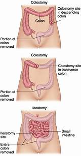 Photos of Colostomy Medical Definition