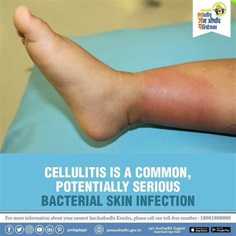 Cellulitis Skin Infection Health Tips Bacterial Infection