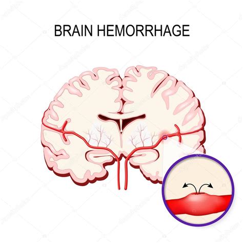 Hemorragia Cerebral Accidente Cerebrovascular Y Hemorragia Dentro Del