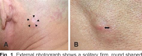 Figure 1 From A Case Of Metastatic Malignant Melanoma Presenting As