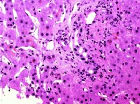 Liver Histology Demonstrated Portal Edema With Neutrophils Infiltrate