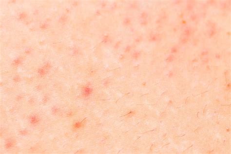 Skin Conditions That Look Like Acne—but Arent The Healthy
