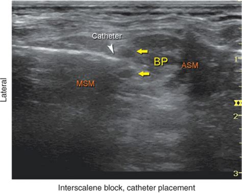 Ultrasound Guided Interscalene Brachial Plexus Block Hadzics