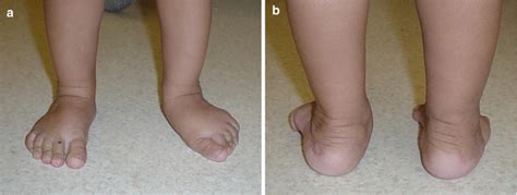 Common Orthopedic Problems In Children Musculoskeletal Key