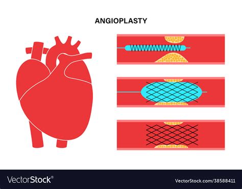 Angioplasty Cardiac Stent Royalty Free Vector Image