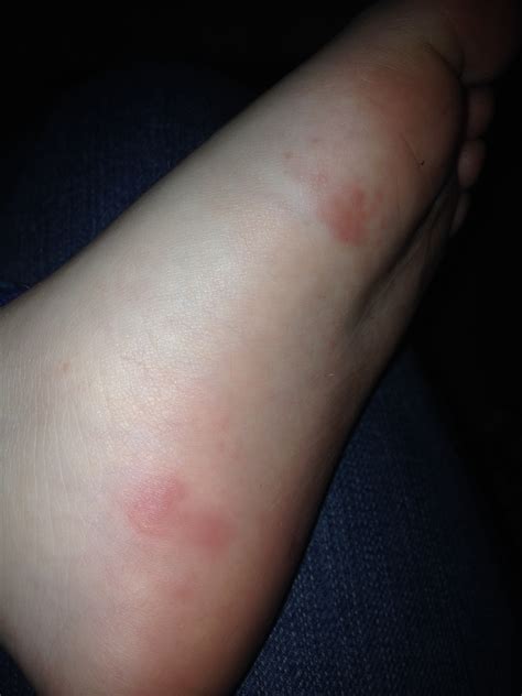 Red Spots On Bottom Of Foot — The Bump