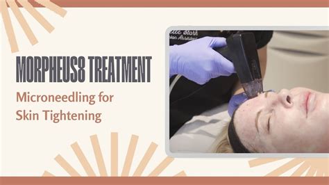 Morpheus8 Treatment Microneedling For Skin Tightening West Hollywood Ca Dr Jason Emer