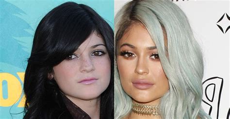 Kylie jenner's plastic surgery timeline - before and after ...