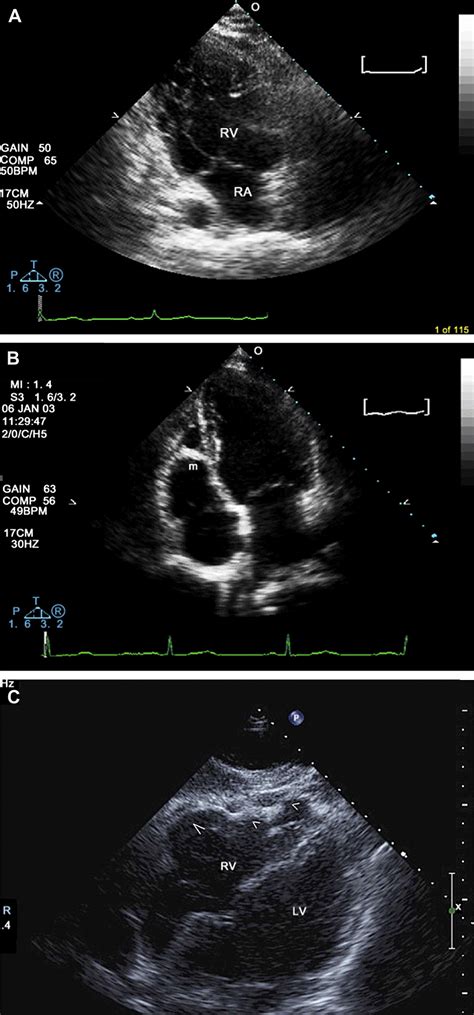 Echocardiography In Arrhythmogenic Cardiomyopathy Cardiac