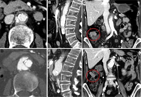 Computed Tomography Ct Scans At Diagnosis A C And At 3 Months Of