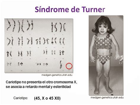 S Ndrome De Turner Introducci N S Ndrome De Turner M Pilar Egea Arias