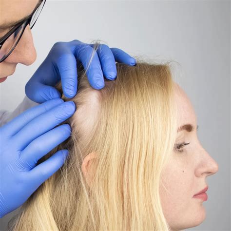 Todo Sobre La Alopecia Areata En Mujeres Microcapilar Hair Clinic