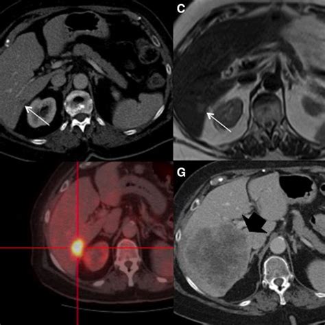Ct Scan Detection Of Ovarian Cancer Recurrence An Axial Post Contrast