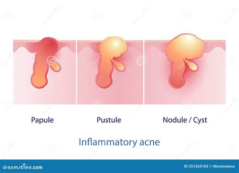 Types Of Inflammatory Acne Papule Pustule Nodule And Cyst Vector On